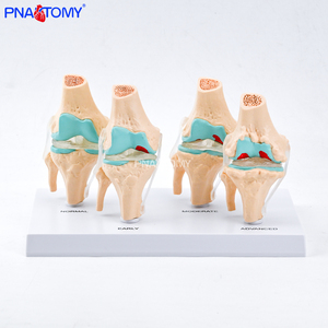 Modelo de Articulación de <span class=keywords><strong>Rodilla</strong></span> Humana de 4 Etapas con Osteoartritis Patológica, Herramienta Educativa para Profesores de Ciencias Anatómicas, Enseñanza Médica - Product Image 5