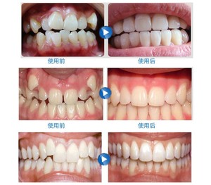 Aparato <span class=keywords><strong>de</strong></span> ortodoncia Dental <span class=keywords><strong>de</strong></span> 3 colores, <span class=keywords><strong>Corrector</strong></span> bucal con caja redonda - Product Image 5