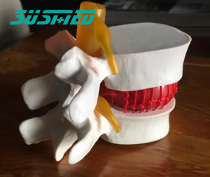 Modèle de démonstration de hernie discale lombaire humaine modèle d'enseignement de l'anatomie de la pathologie discale - Product Image 3