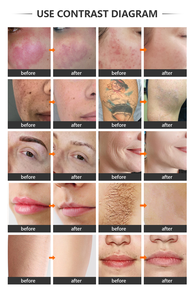 Máquina Profesional 2 en 1 de Depilación Láser de Diodo y Eliminación de Tatuajes 808 755 1064nm, Rejuvenecimiento Cutáneo con Picosegundos, Semiconductor Comercial - Product Image 6