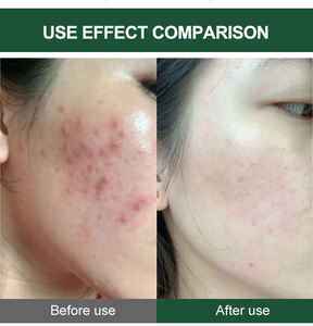 T Private Logo 7 Couleurs Naturel Spongilla Spicules Vert Algues Peeling Kit pour la Réparation de la Peau Fade Acné Cicatrices Élimination des Taches Sombres - Product Image 6