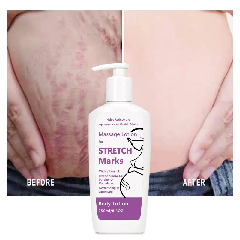 Groothandel Littekenverwijderingscrème Effectief Diep Acne Litteken Voor Benen En Dijen Voor Vrouwelijke Stretch Mark Cream Set