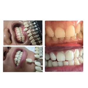 High Quality 3D <b>Teeth</b> <b>Whitening</b> Dental Led Light Kexe AGF53 - Product Image 5