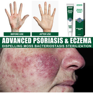 South Moon OEM Cuidado de la Piel, <span class=keywords><strong>Crema</strong></span> Herbal China <span class=keywords><strong>para</strong></span> Limpieza Facial, Salud, Psoriasis, <span class=keywords><strong>Dermatitis</strong></span>, Eccema, Prurito, Ungüento <span class=keywords><strong>para</strong></span> Psoriasis - Product Image 3