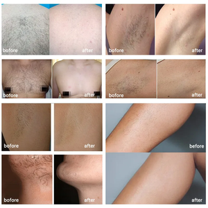 Winkonlaser 2026 - Máquina Profesional <span class=keywords><strong>de</strong></span> Depilación Láser <span class=keywords><strong>de</strong></span> Diodo <span class=keywords><strong>de</strong></span> Hielo <span class=keywords><strong>de</strong></span> 808 nm, 1200 W, 3000 W, 755/808/940/1064 - Product Image 6