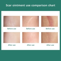 Soulagement des vergetures et brûlures visage peau pores dissolvant crème visage peau réparation cicatrice élimination crème