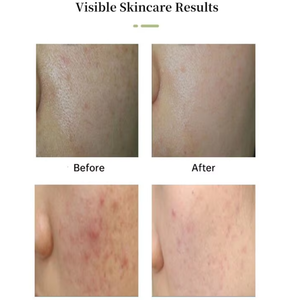 Cosmético Coreano <span class=keywords><strong>Dr</strong></span>.Innoderm, Sérum para el Cuidado de la Piel, Ampolla Multi-Péptidos, Blanqueador, Antienvejecimiento, Terapia Facial MTS, 5.5ml*10 viales, Hecho en Corea - Product Image 4