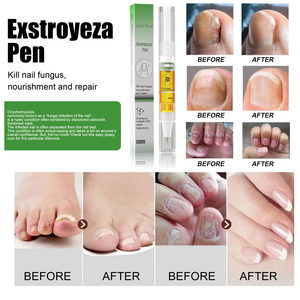 South Moon Aceite Esencial para <span class=keywords><strong>Hongos</strong></span> <span class=keywords><strong>en</strong></span> las Uñas, Onicomicosis, Paroniquia, Aclaramiento de Uñas de los Pies, Cuidado de los Pies - Product Image 4