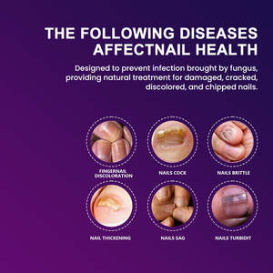 Kräuter salbe zur Behandlung von Nagel pilzen Fußpflege zur Pilz entfernung von Zehennägeln Gesundheits versorgung - Product Image 3
