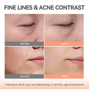 TOUCHBeauty Led Masques Faciaux Professionnel Salon Grade Visage Rouge Led Light Therapy Masque de Beauté pour Anti-rides Éclaircir - Product Image 4