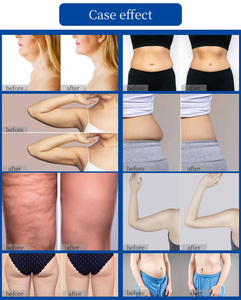 เครื่องกำจัดไขมันด้วยคลื่นไมโครเวฟแบบเย็น Cryo Cold พร้อมหัวจับหลายหัว สำหรับกระชับสัดส่วนและปรับรูปร่าง ระบบแช่แข็งแบบไม่รุกล้ำ - Product Image 3