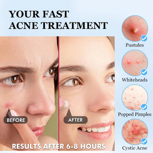 2025 cerotti per l'acne idrocolloide diretti in fabbrica per medicazione nasale e senza corpo e copertura per brufoli direttamente dalla fonte - Product Image 3