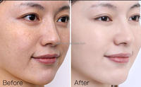 Crème éclaircissante Rejeon, effet identique à Cosmelan, résout efficacement le mélasma, les taches brunes, l'hyperpigmentation