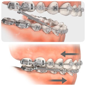 Dispositivo resistente ortodontico durevole per la cura orale per una correzione efficace della malocclusione di classe II - Product Image 6