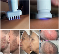 Appareil professionnel de peeling cutané à jet froid haute puissance pour le soin du visage et du cuir chevelu