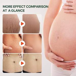 Greenlem tự nhiên vết rạn da và vết sẹo dầu da sửa chữa dầu cho cơ thể sử dụng hiệu quả trong căng đánh dấu và loại bỏ Tummy tuck dầu - Product Image 3