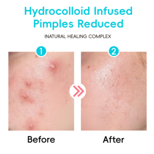 <span class=keywords><strong>2025</strong></span> mới mùa thu Hazel giai điệu in mụn trứng cá các bản vá lỗi OEM biểu tượng tùy chỉnh Hydrocolloid dán tại chỗ kháng khuẩn dầu cân bằng Vitamin C - Product Image 6