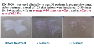 Potente Mini 308nm Excimer Laser System Nueva tendencia Lámpara de fototerapia de luz médica 311nm <span class=keywords><strong>UVB</strong></span> para equipo de fisioterapia - Product Image 4