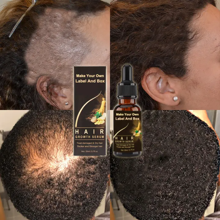 גבוהה רווח במפעל מחיר שיער גידול מוצרים עבור שחור איש שיער אובדן