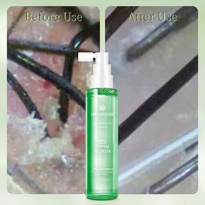 <span class=keywords><strong>Spray</strong></span> apaisant pour cuir chevelu en gros pour cuir chevelu qui démange avec hamamélis et glycyrrhizate de dipotassium Soulagement instantané Réduit l'irritation - Product Image 1