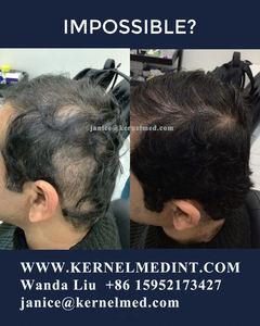 Solución LLLT efectiva Terapia con láser de bajo nivel para la <span class=keywords><strong>alopecia</strong></span> con 424 diodos Kernel Cobertura MÁXIMA DE LA KN-8000A - Product Image 5