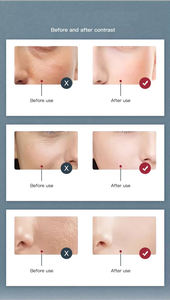 معدات شد الوجه ميكروكرنت معدات صالون تشديد ميكروكرنت غير الغازية جمال الوجه - Product Image 3