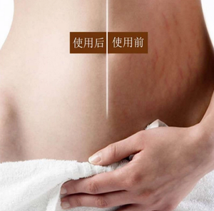 Crème pour éliminer les vergetures <span class=keywords><strong>et</strong></span> la <span class=keywords><strong>cellulite</strong></span> du ventre, pour le traitement des cicatrices - Product Image 3