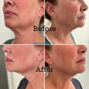 Láser <span class=keywords><strong>de</strong></span> Diodo Acoplado a Fibra <span class=keywords><strong>de</strong></span> Biquarzo <span class=keywords><strong>de</strong></span> 30W, 1470nm 980nm 635nm, para Lipólisis Quirúrgica Precisa, Cierre Vascular y <span class=keywords><strong>Terapia</strong></span> Endovenosa - Product Image 6