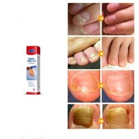 Crème naturelle à base de plantes pour l'élimination des mycoses des ongles, pommade anti-infectieuse pour les soins des mains, des pieds et du corps, en gros