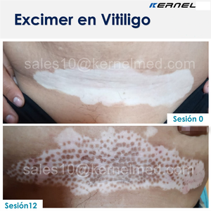Láser Excimer UVB Kernel KN-5000C de 308nm para Fototerapia de Psoriasis, Vitíligo y <span class=keywords><strong>Dermatitis</strong></span> <span class=keywords><strong>Atópica</strong></span> - Product Image 2