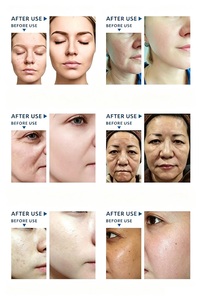 Appareil de beauté multifonction 7-en-1 Hydr AMachine, nettoyage en profondeur des pores, <span class=keywords><strong>anti</strong></span>-points noirs, <span class=keywords><strong>anti</strong></span>-acné, raffermissement de la peau, directement de l'usine - Product Image 4