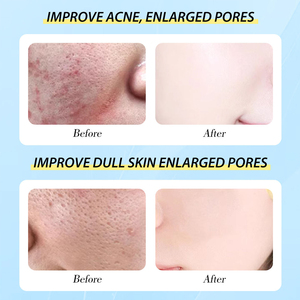 سيروم مضاد لحب الشباب لإزالة ندبات حب الشباب، سيروم للوجه للتحكم في الزيوت وإزالة البثور، أفضل سيروم لحب الشباب يحتوي على حمض الساليسيليك - Product Image 3