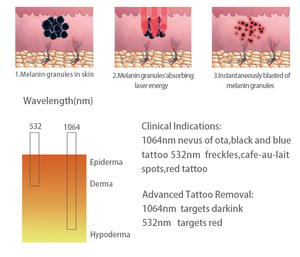 Máquina Picosend para Eliminación de Tatuajes, Máquina Pico para Eliminación de Cejas, <span class=keywords><strong>Precio</strong></span> de la Máquina - Product Image 5