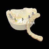Prothèse dentaire implantée avec piliers en titane et couronne en zircone, fabrication sur mesure CAD/CAM pour cliniques et laboratoires dentaires