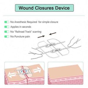 Nasal Fix Plaster Catheter Tube Securement Device Gentle Non Woven NGT General Medical Supplies - Product Image 5