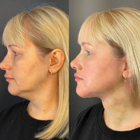 Chirurgie médicale Lipo Laser Dispositif 980nm 1470nm Diode Laser Liposuccion Corps Façonner Machine Raffermissant Visage Endolaser Lift