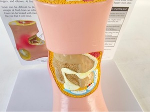 Modè<span class=keywords><strong>le</strong></span> de pied pathologique en PVC de marque Yulin pour la communication avec <span class=keywords><strong>les</strong></span> patients, pour la goutte, <span class=keywords><strong>les</strong></span> complications, l'arthrite, l'articulation du pied <span class=keywords><strong>et</strong></span> de la cheville - Product Image 2