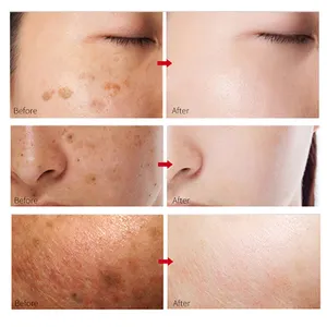 Correcteur de taches foncées soins de la peau hydratant anti-taches de rousseur coréen crème pour le visage
