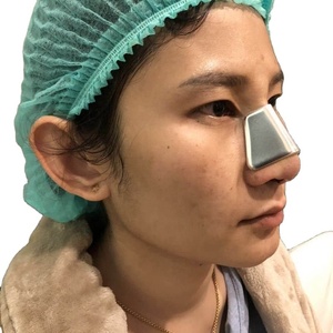 Attelle nasale en aluminium pour rhinoplastie, fixation <span class=keywords><strong>externe</strong></span> orthopédique pour fracture du nez, support de pont nasal - Product Image 1