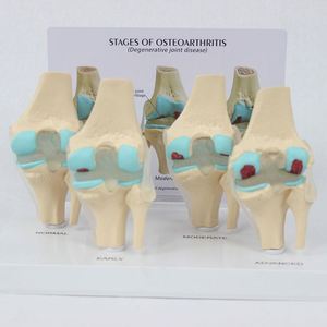Modelo de articulación de rodilla humana de 4 etapas con tarjeta posterior, recurso didáctico de esqueleto de rodilla, modelo de articulación de rodilla con patología. - Product Image 3