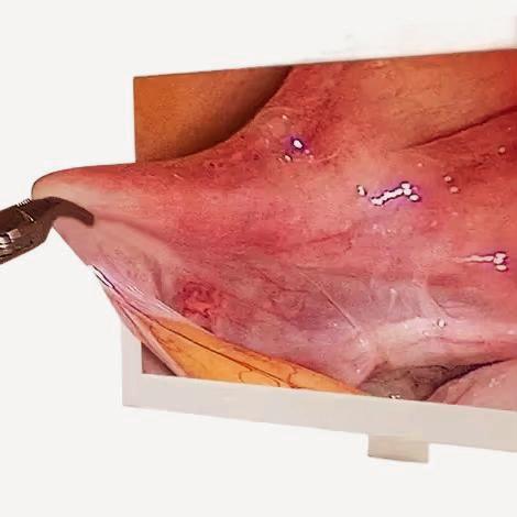 1080P HD Endoscopy Tower 3D Camera Surgical Instruments for Laparoscopic Surgery Equipment