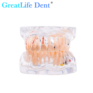 Modelo de Estudio de Patología Dental Greatlife Dent XVD2530 con Certificación CE Clase I, Implante Dental de 32 Dientes, Diseño Transparente - Product Image 2