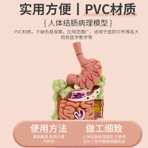 Modèle de simulation pédagogique de la pathologie du côlon humain, des maladies gastro-intestinales, des lésions du côlon, des maladies intestinales, des lésions du côlon - Product Image 4