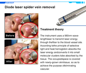 Fotobiomodulación en Odontología Estética y Curación de Heridas, Onicomicosis, 980nm, <span class=keywords><strong>Tratamiento</strong></span> de <span class=keywords><strong>Arañas</strong></span> <span class=keywords><strong>Vasculares</strong></span>, Hongos en las Uñas y <span class=keywords><strong>Tratamiento</strong></span> Dental - Product Image 3