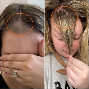 Shampooing contre le <span class=keywords><strong>psoriasis</strong></span> 2% extrait de goudron de houille traitement du cuir chevelu squameux et démangeaisons pour le <span class=keywords><strong>psoriasis</strong></span> du cuir chevelu dermatite séborrhéique pellicules et eczéma