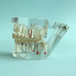 Modelo Dental Transparente <span class=keywords><strong>de</strong></span> Tamaño Real con Dientes Patológicos para Demostración en la Enseñanza Dental - Product Image 5