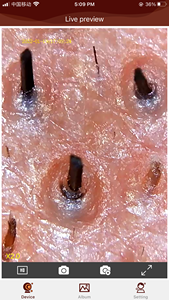 Dermatoscopie numérique polarisante HD 1080P 2MP pour l'analyse de la peau Pores de la peau obstrués - Product Image 2