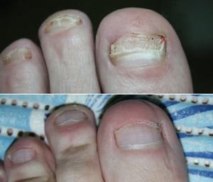 Laser Podiatri Kelas IV 2024 980nm/1064nm untuk Pengobatan Jamur Kuku, Penggunaan Klinik, Laser Onikomikosis Portabel - Product Image 5