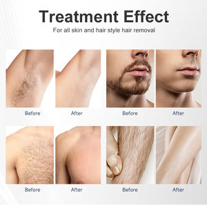 Épilateur <span class=keywords><strong>laser</strong></span> diode <span class=keywords><strong>Soprano</strong></span> <span class=keywords><strong>Titanium</strong></span> certifié CE 808 nm, machine d'épilation <span class=keywords><strong>laser</strong></span> diode 755 nm 808 nm 1064 nm - Product Image 4