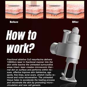 מכשיר לייזר CO2 איכותי ביותר להסרת סימני מתיחה וצלקות, מקל להידוק הנרתיק - Product Image 3